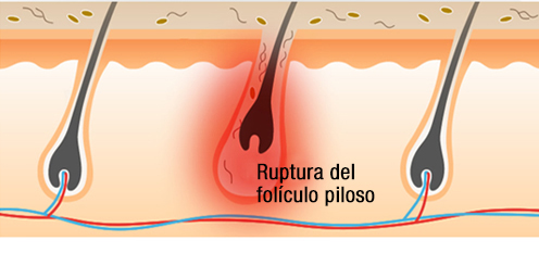 causa